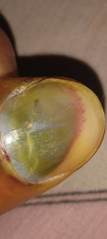 Extreme close up of a discolored infected toenail with green and yellow nail bed discoloration