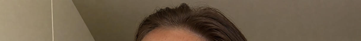 Close up view of a receding dark brown hairline against a plain beige indoor wall
