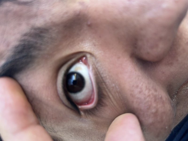 Close-up of a wide, bulging eye with red sclera and visible iris.