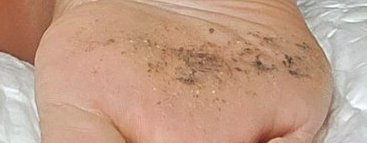 Close up of a human heel showing dark cracked discoloration, dry scaly patches, and small raised ...